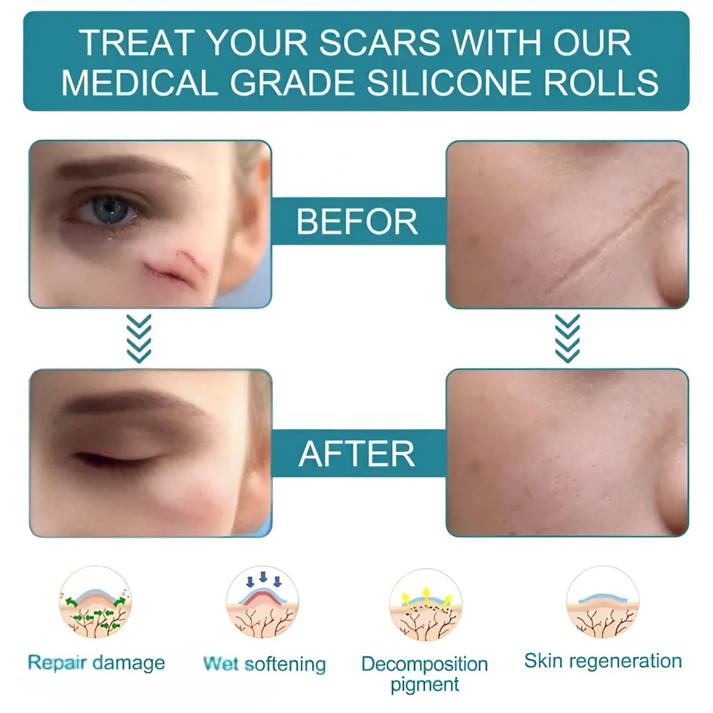 Silicone Scar Tape Sheet for Surgical, Injury & Acne Scars & Marks