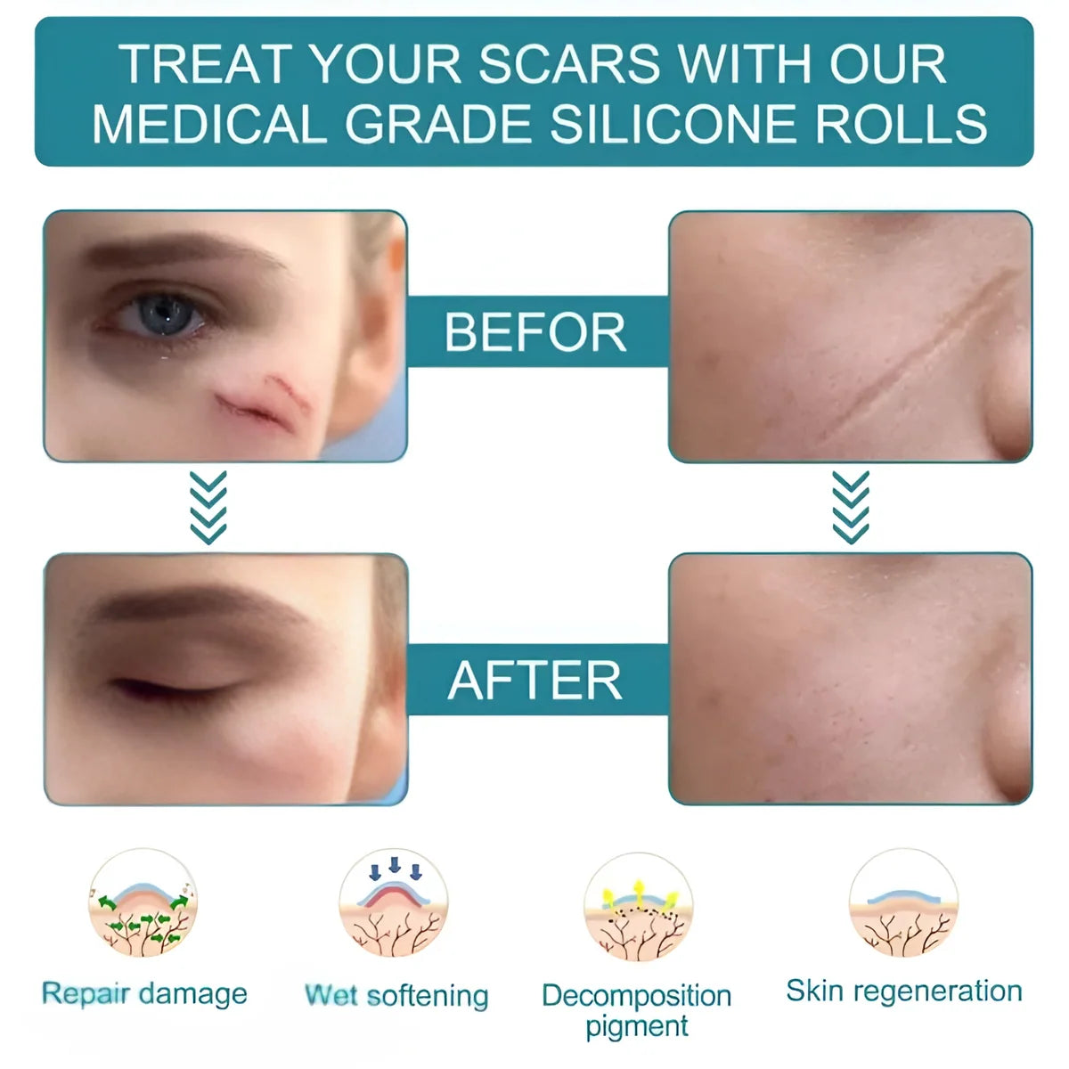 Silicone Scar Tape Sheet for Surgical, Injury & Acne Scars & Marks