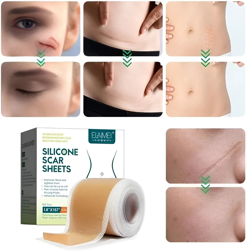 Silicone Scar Tape Sheet for Surgical, Injury & Acne Scars & Marks