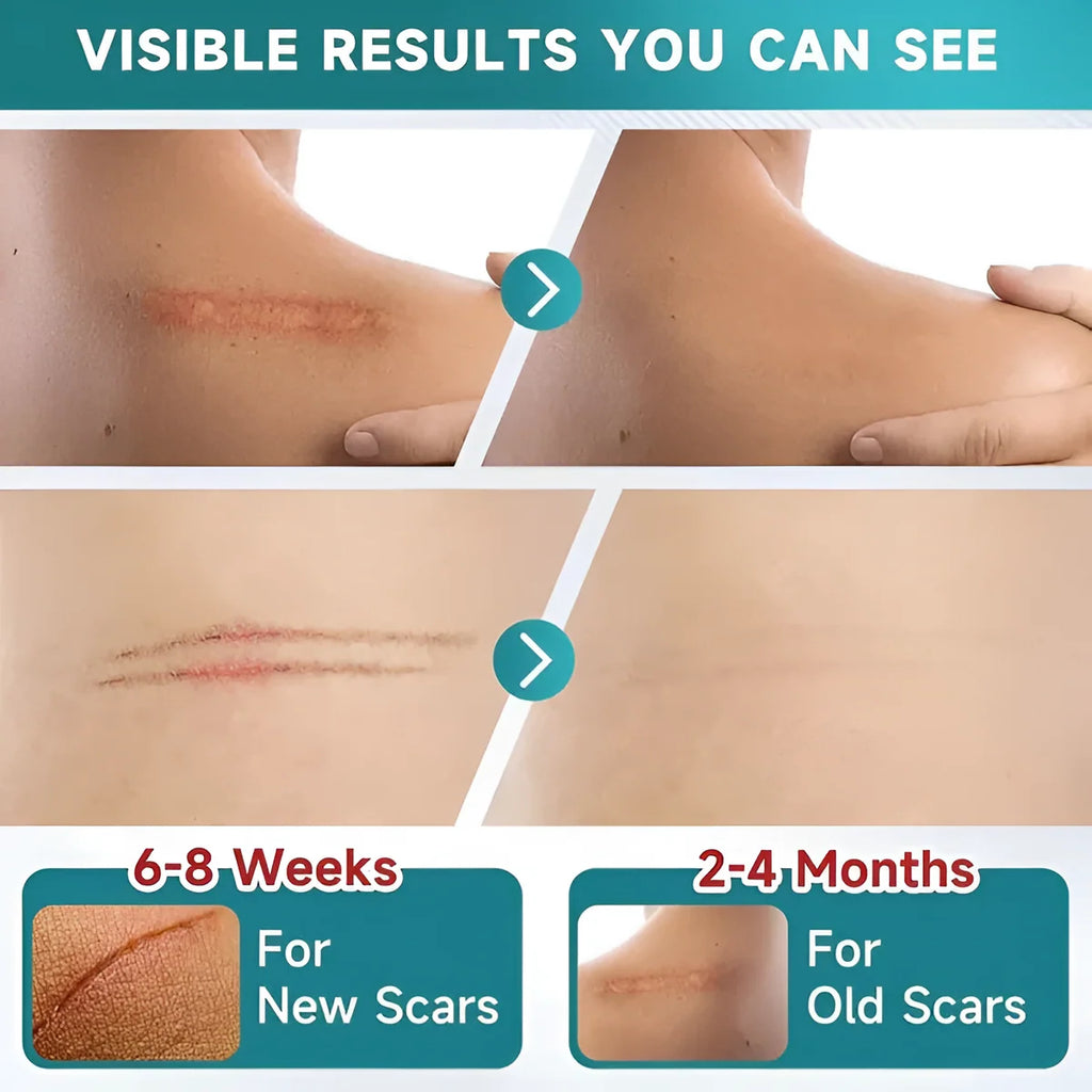 Silicone Scar Tape Sheet for Surgical, Injury & Acne Scars & Marks