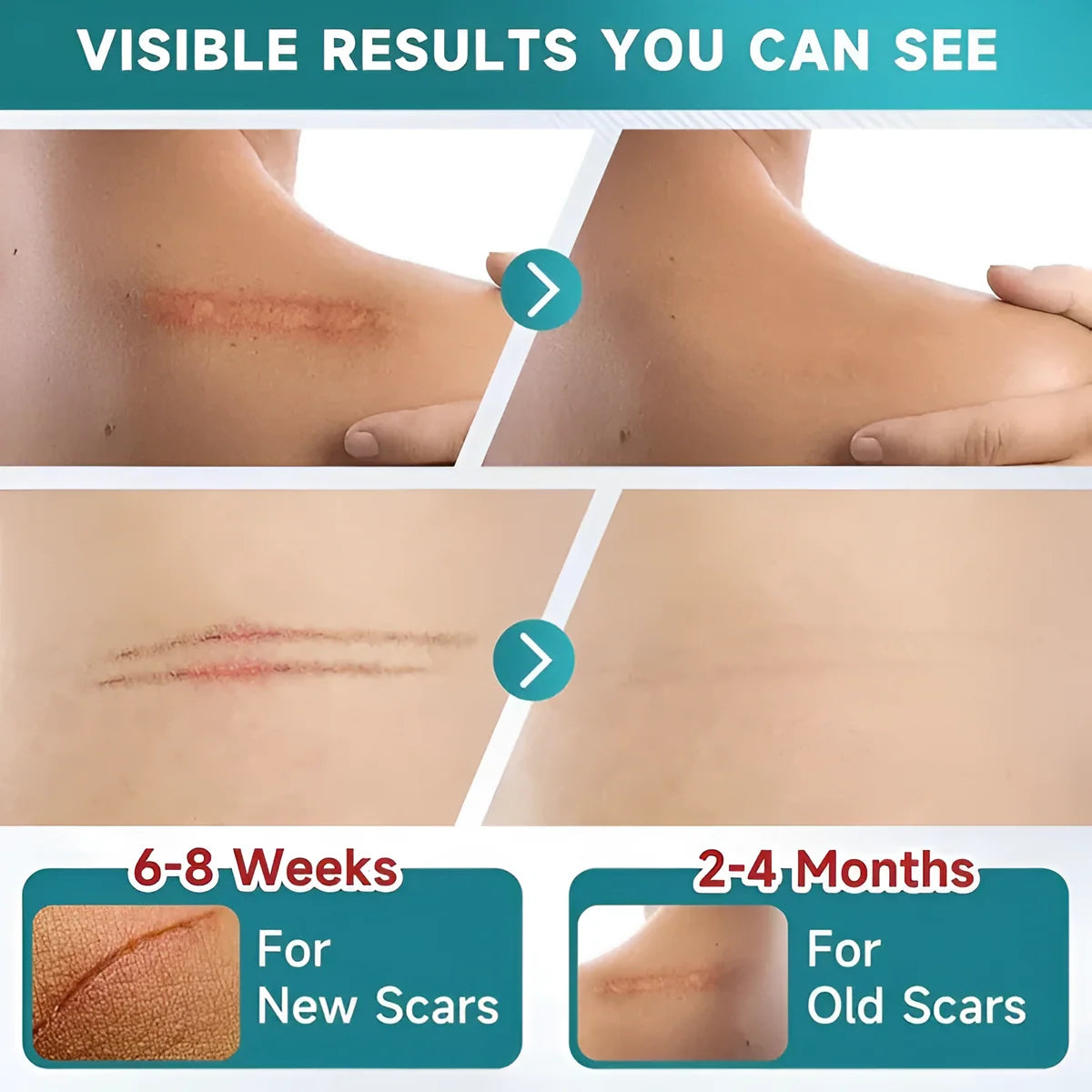 Silicone Scar Tape Sheet for Surgical, Injury & Acne Scars & Marks