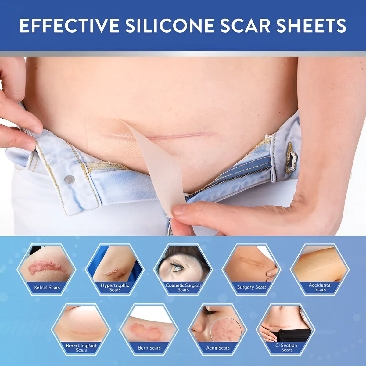 Silicone Scar Tape Sheet for Surgical, Injury & Acne Scars & Marks